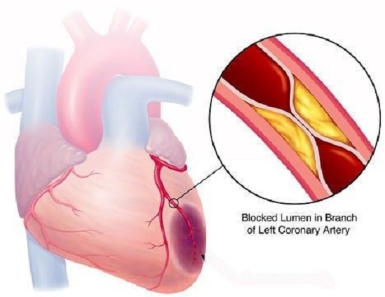 心绞痛的主要致病原因是冠状动脉的闭塞